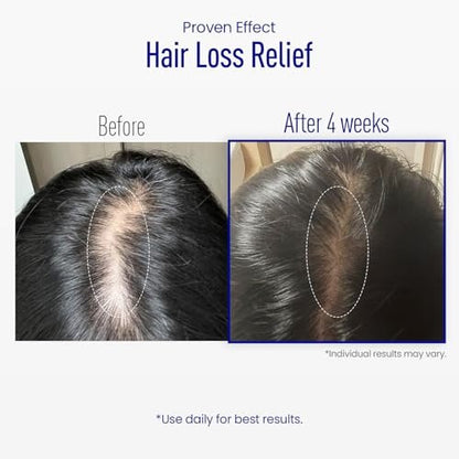 ViveLab Scalp Microneedle Serum – K-beauty Hair Growth & Scalp Treatment with Spioxyl™ 400 | Fills Hair Part Line, Strengthens Roots, Reduces Hair Thinning – 220,000 Microneedle Formula Avelisse