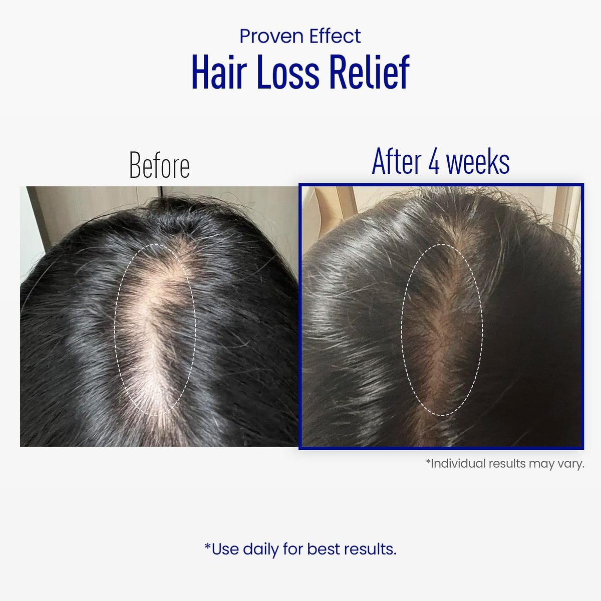 ViveLab Scalp Microneedle Serum – K-beauty Hair Growth & Scalp Treatment with Spioxyl™ 400 | Fills Hair Part Line, Strengthens Roots, Reduces Hair Thinning – 220,000 Microneedle Formula Avelisse