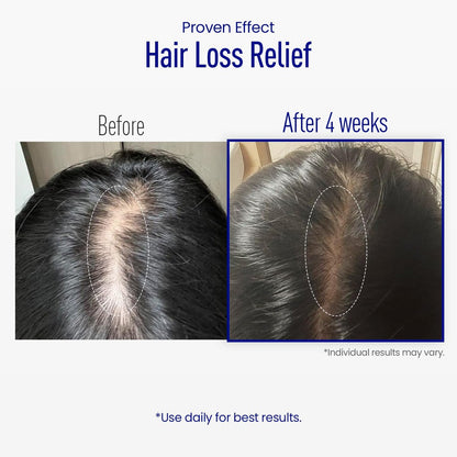 ViveLab Scalp Microneedle Serum – K-beauty Hair Growth & Scalp Treatment with Spioxyl™ 400 | Fills Hair Part Line, Strengthens Roots, Reduces Hair Thinning – 220,000 Microneedle Formula Avelisse
