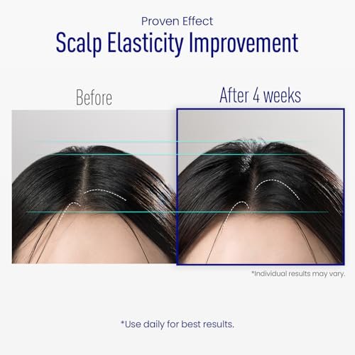 ViveLab Scalp Microneedle Serum – K-beauty Hair Growth & Scalp Treatment with Spioxyl™ 400 | Fills Hair Part Line, Strengthens Roots, Reduces Hair Thinning – 220,000 Microneedle Formula Avelisse