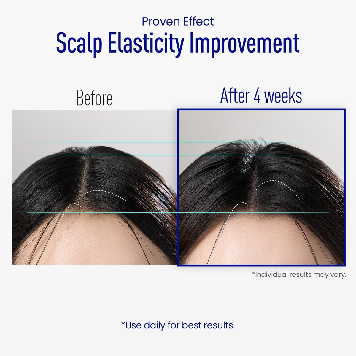 ViveLab Scalp Microneedle Serum – K-beauty Hair Growth & Scalp Treatment with Spioxyl™ 400 | Fills Hair Part Line, Strengthens Roots, Reduces Hair Thinning – 220,000 Microneedle Formula Avelisse