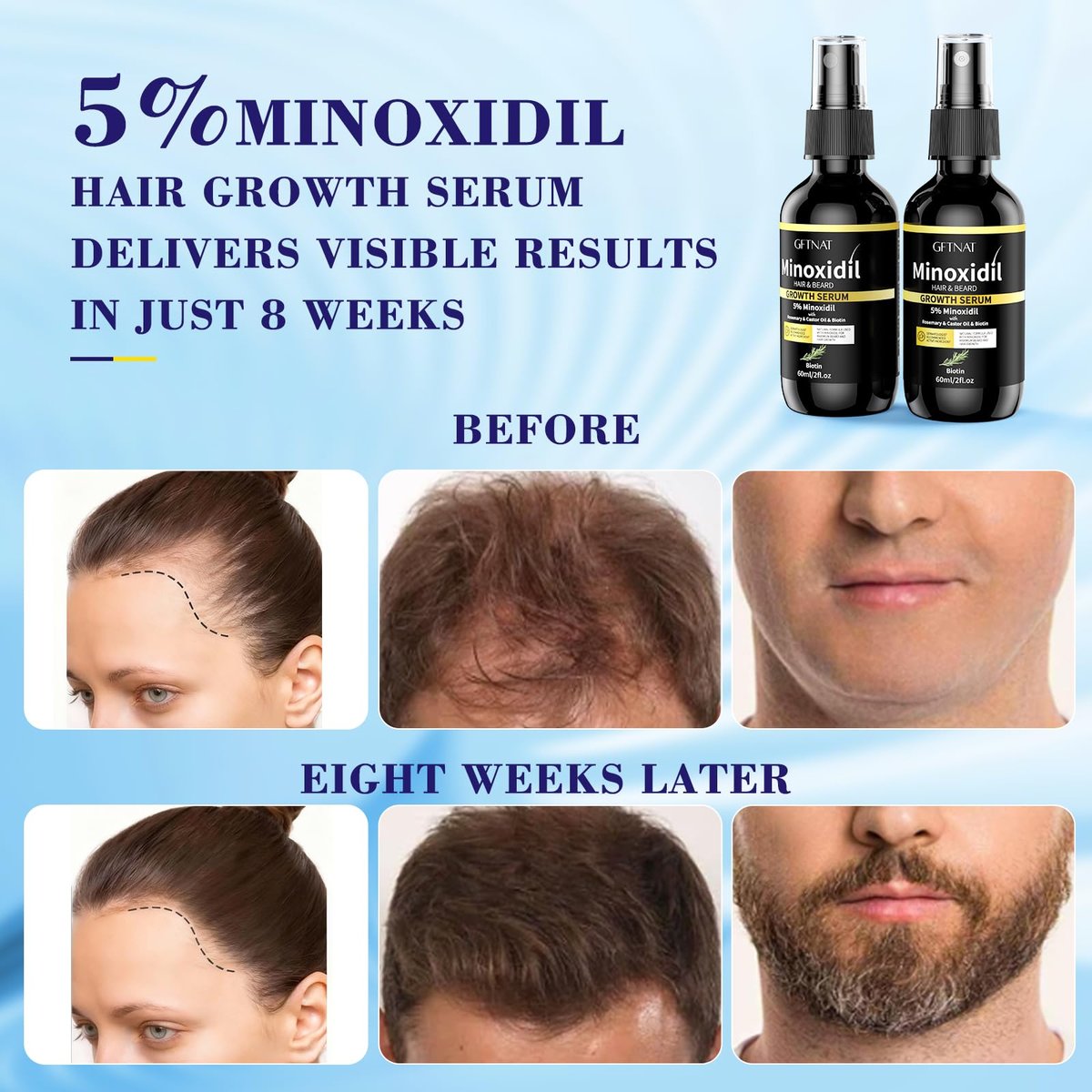 5% Minoxidil Spray for Men and Women Hair Loss Solution with Biotin and Rosemary Hair Growth Serum, Extra Strength 5 Percent Minoxidil for Thicker Fuller Hair Regrowth, 2 Fl Oz (Pack of 2) Avelisse