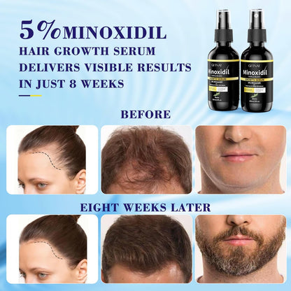 5% Minoxidil Spray for Men and Women Hair Loss Solution with Biotin and Rosemary Hair Growth Serum, Extra Strength 5 Percent Minoxidil for Thicker Fuller Hair Regrowth, 2 Fl Oz (Pack of 2) Avelisse