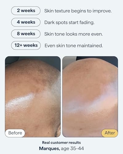Advanced Discoloration Correcting Serum for Dark Spots | Retinol, Kojic Acid, Tranexamic Acid, Niacinamide, Mandelic Acid | Fragrance Free | Sensitive Skin | By Dermatologist Dr. Shah | 1 fl oz Avelisse