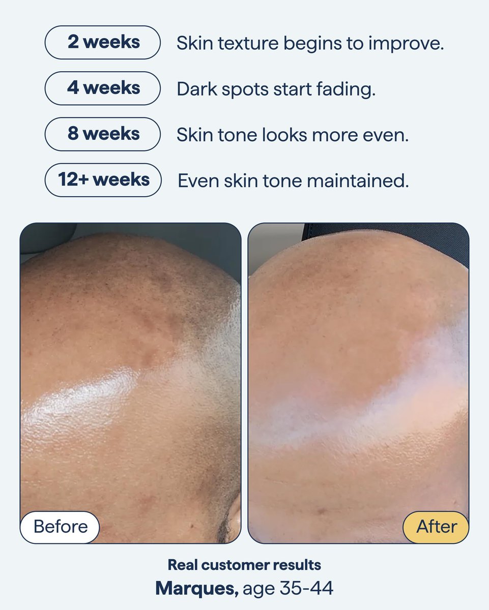 Advanced Discoloration Correcting Serum for Dark Spots | Retinol, Kojic Acid, Tranexamic Acid, Niacinamide, Mandelic Acid | Fragrance Free | Sensitive Skin | By Dermatologist Dr. Shah | 1 fl oz Avelisse