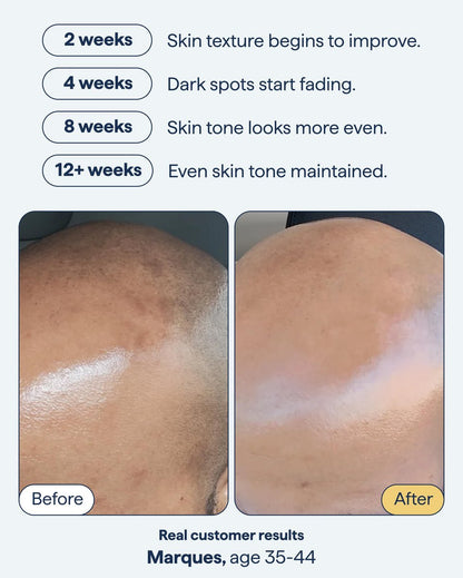 Advanced Discoloration Correcting Serum for Dark Spots | Retinol, Kojic Acid, Tranexamic Acid, Niacinamide, Mandelic Acid | Fragrance Free | Sensitive Skin | By Dermatologist Dr. Shah | 1 fl oz Avelisse