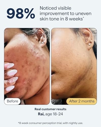 Advanced Discoloration Correcting Serum for Dark Spots | Retinol, Kojic Acid, Tranexamic Acid, Niacinamide, Mandelic Acid | Fragrance Free | Sensitive Skin | By Dermatologist Dr. Shah | 1 fl oz Avelisse