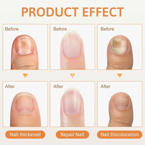 2-Pack Bee Venom Nail Soothing Spray - Advanced Nail Repair & Nourishing Treatment for Toenails and Fingernails Avelisse