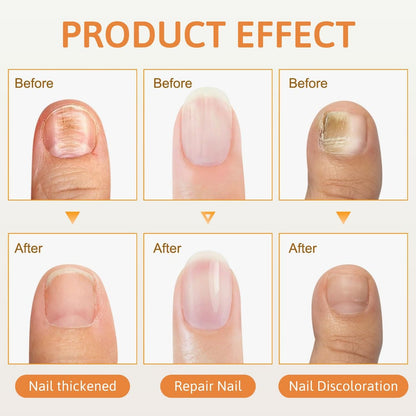 2-Pack Bee Venom Nail Soothing Spray - Advanced Nail Repair & Nourishing Treatment for Toenails and Fingernails Avelisse