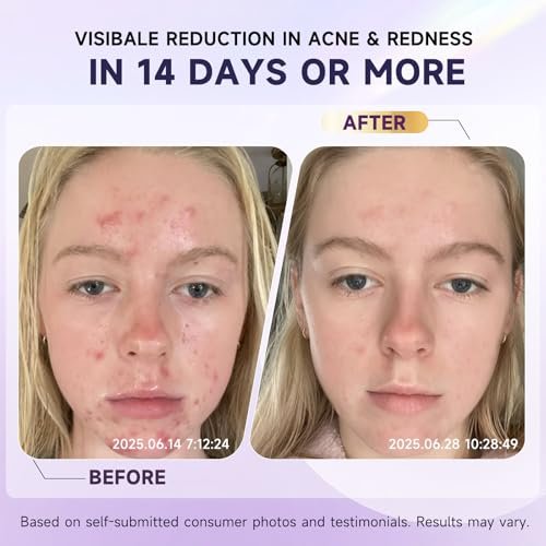 10% Azelaic Acid Acne Treatment for Face – Hormonal/Cystic Acne Spot Treatment Cream | Redness Reducing Acne Moisturizer for Rosacea & Sensitive, Acne-Prone Skin | Teens & Adults, 1.7 oz - görsel 8