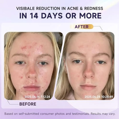 10% Azelaic Acid Acne Treatment for Face – Hormonal/Cystic Acne Spot Treatment Cream | Redness Reducing Acne Moisturizer for Rosacea & Sensitive, Acne-Prone Skin | Teens & Adults, 1.7 oz