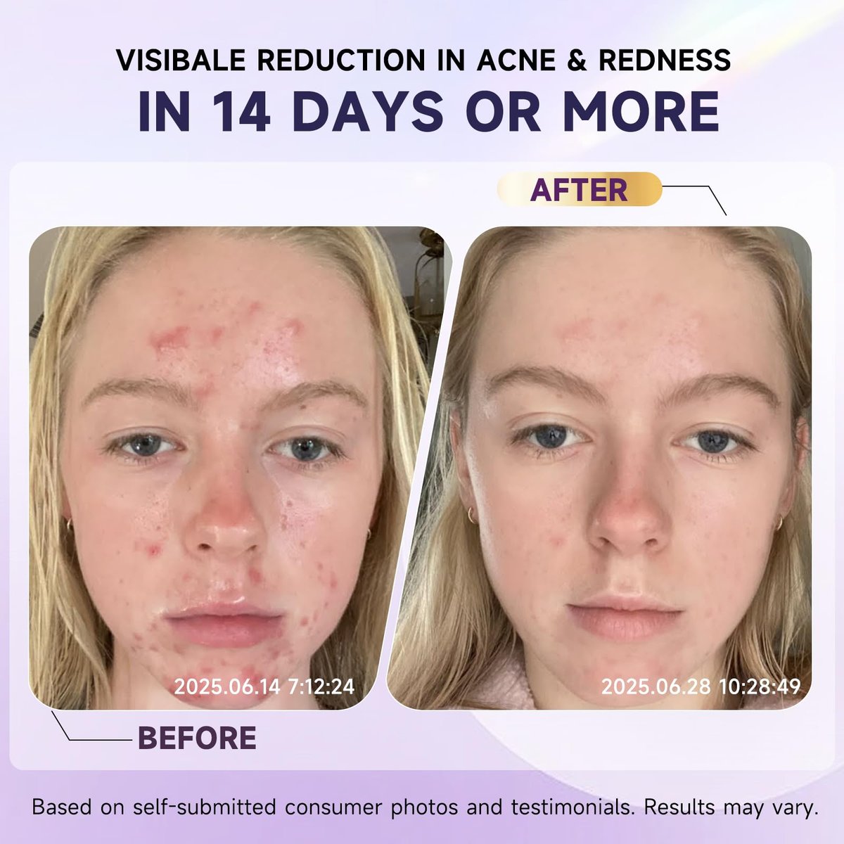10% Azelaic Acid Acne Treatment for Face – Hormonal/Cystic Acne Spot Treatment Cream | Redness Reducing Acne Moisturizer for Rosacea & Sensitive, Acne-Prone Skin | Teens & Adults, 1.7 oz - görsel 7