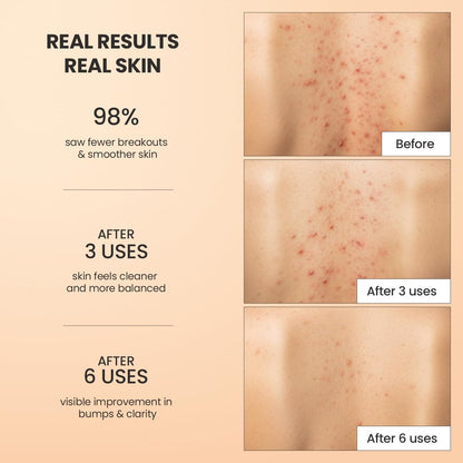 BellamiLuxx Body Acne Treatment Scrub - Helps Reduce Body Breakouts on Back, Chest, Butt & Thighs - Back Acne Treatment for Men, Women & Teens - Butt Acne Wash with Natural Actives for Smooth Skin Avelisse