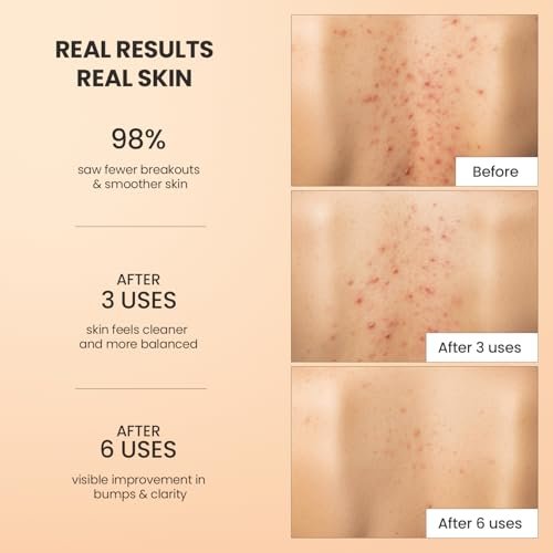 BellamiLuxx Body Acne Treatment Scrub - Helps Reduce Body Breakouts on Back, Chest, Butt & Thighs - Back Acne Treatment for Men, Women & Teens - Butt Acne Wash with Natural Actives for Smooth Skin Avelisse