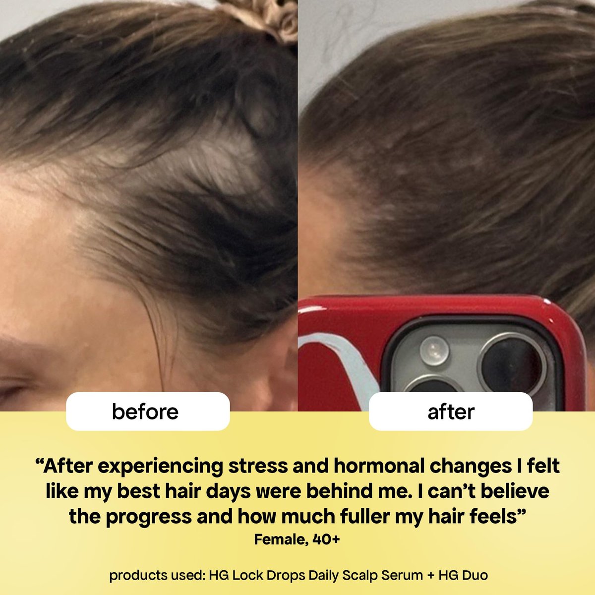 BondiBoost HG Lock Drops Daily Hair Serum for Women – Non-Greasy Hair Thinning Treatment, Stimulates Scalp for Thicker Fuller Hair – Vegan, Color-Safe Lightweight Serum for All Hair Types Avelisse