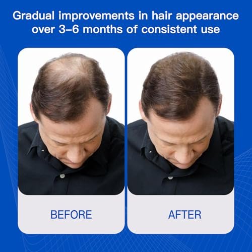 Rosemary Hair Growth Serum with Redensyl and Anagain – Roll On 25 ml, Thicker & Stronger Hair, Prevents Hair Fall & Stimulates Hair Follicles, Fights Hair Thinning & Hair Loss for All Hair Types Avelisse