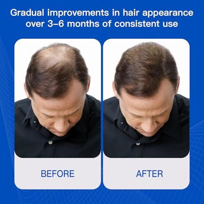 Rosemary Hair Growth Serum with Redensyl and Anagain – Roll On 25 ml, Thicker & Stronger Hair, Prevents Hair Fall & Stimulates Hair Follicles, Fights Hair Thinning & Hair Loss for All Hair Types Avelisse