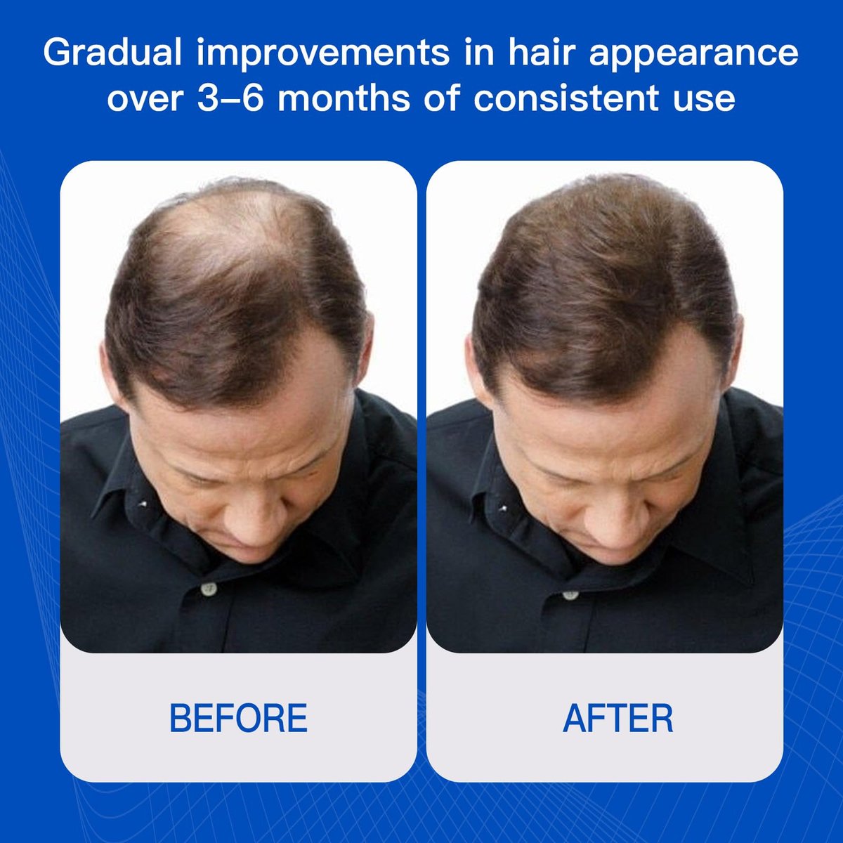 Rosemary Hair Growth Serum with Redensyl and Anagain – Roll On 25 ml, Thicker & Stronger Hair, Prevents Hair Fall & Stimulates Hair Follicles, Fights Hair Thinning & Hair Loss for All Hair Types Avelisse