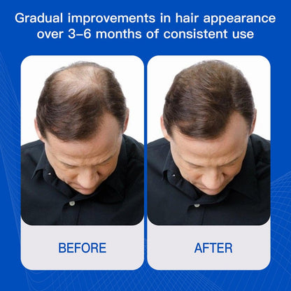 Rosemary Hair Growth Serum with Redensyl and Anagain – Roll On 25 ml, Thicker & Stronger Hair, Prevents Hair Fall & Stimulates Hair Follicles, Fights Hair Thinning & Hair Loss for All Hair Types Avelisse