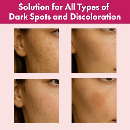 Roseblem Arbutin 7% + Tranexamic Acid 4% Face Cream for Dark Spots & Uneven Skin Tone – Hydrating, Non-Irritating, Safe for Sensitive Skin 1.76 oz