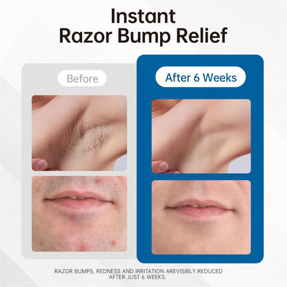 Razor Bumps & Ingrown Hair Treatment – Smoothing Solution for Body, Beard & Bikini Area – Post Waxing & After Shaving Serum for Women & Men