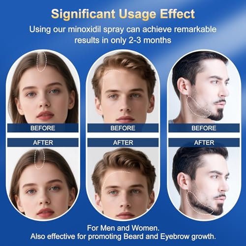 5% Minoxidil Hair Growth Serum for Men & Women | Extra Strength with Biotin | 6-Month Supply (4 Pack, 14 fl oz) | Clinically Proven Hair Regrowth Treatment for Thinning Hair & Beard Growth Avelisse