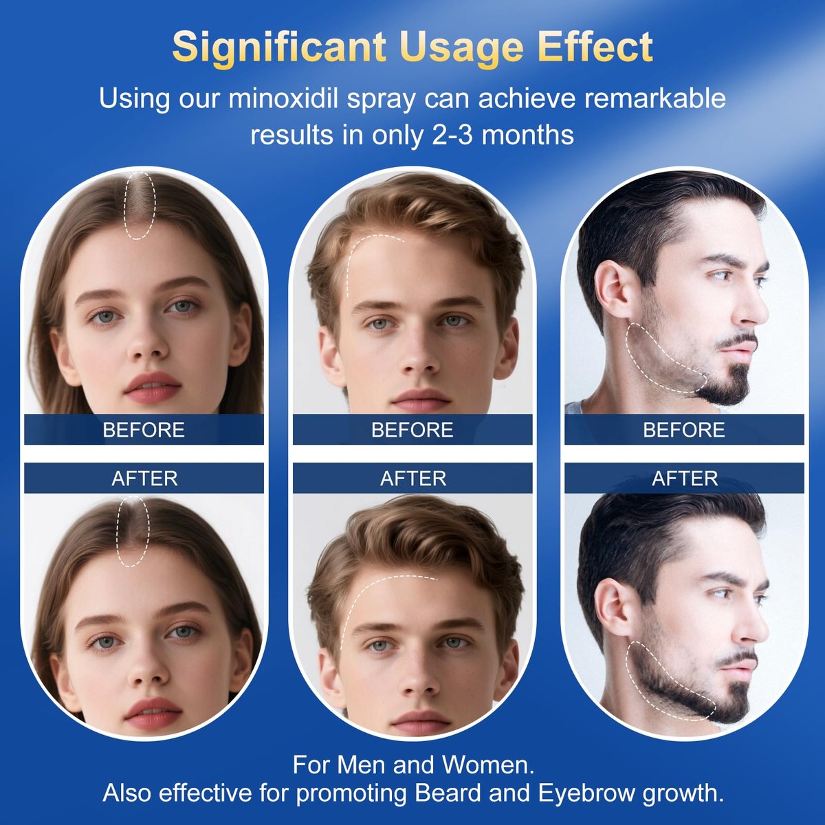 5% Minoxidil Hair Growth Serum for Men & Women | Extra Strength with Biotin | 6-Month Supply (4 Pack, 14 fl oz) | Clinically Proven Hair Regrowth Treatment for Thinning Hair & Beard Growth Avelisse