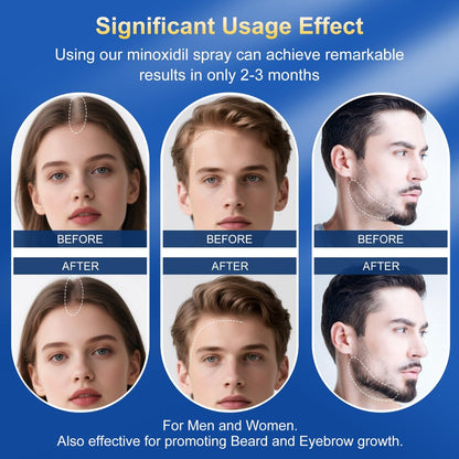 5% Minoxidil Hair Growth Serum for Men & Women | Extra Strength with Biotin | 6-Month Supply (4 Pack, 14 fl oz) | Clinically Proven Hair Regrowth Treatment for Thinning Hair & Beard Growth Avelisse