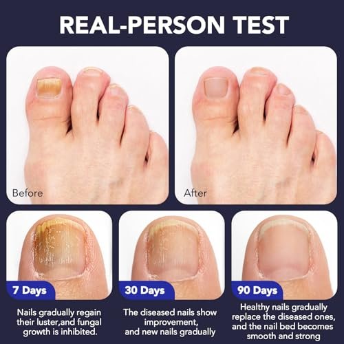 OMZOK Toenail Fungus Pen - 25% Undecylenic Acid & Tea Tree Oil Extra Strength Treatment for Damaged Nails - 5 Pens Avelisse
