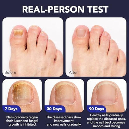 OMZOK Toenail Fungus Pen - 25% Undecylenic Acid & Tea Tree Oil Extra Strength Treatment for Damaged Nails - 5 Pens Avelisse