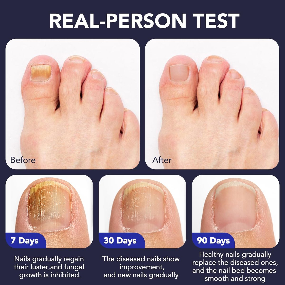 OMZOK Toenail Fungus Pen - 25% Undecylenic Acid & Tea Tree Oil Extra Strength Treatment for Damaged Nails - 5 Pens Avelisse