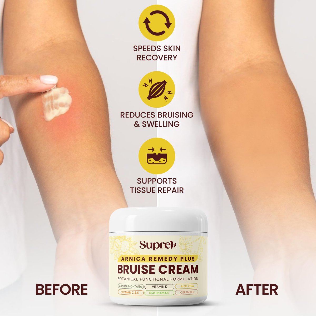 SupreH Arnica Bruise Cream Extra Strength with Vitamin K, C, E, Niacinamide & Ceramide for Bruising, Swelling, Discoloration & Thin Skin - 1 oz Avelisse