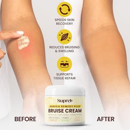 SupreH Arnica Bruise Cream Extra Strength with Vitamin K, C, E, Niacinamide & Ceramide for Bruising, Swelling, Discoloration & Thin Skin - 1 oz Avelisse
