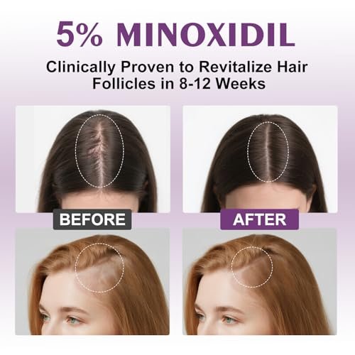 5% Minoxidil Spray for Women - 4 Pack, Hair Regrowth Treatment with Biotin, Supports Thicker & Fuller Hair (13oz, 7 Month Supply) Avelisse