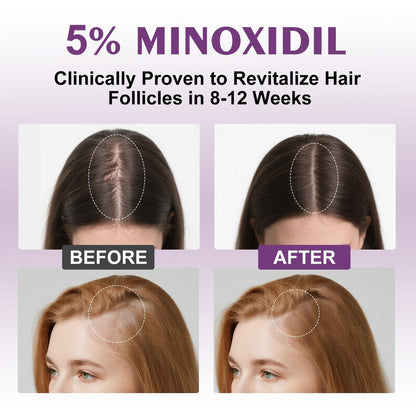 5% Minoxidil Spray for Women - 4 Pack, Hair Regrowth Treatment with Biotin, Supports Thicker & Fuller Hair (13oz, 7 Month Supply) Avelisse