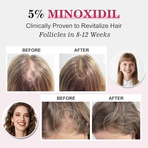 5% Minoxidil Hair Regrowth Spray for Women with Biotin – Extra Strength Treatment for Hair Loss and Thinning (3 Bottles) Avelisse