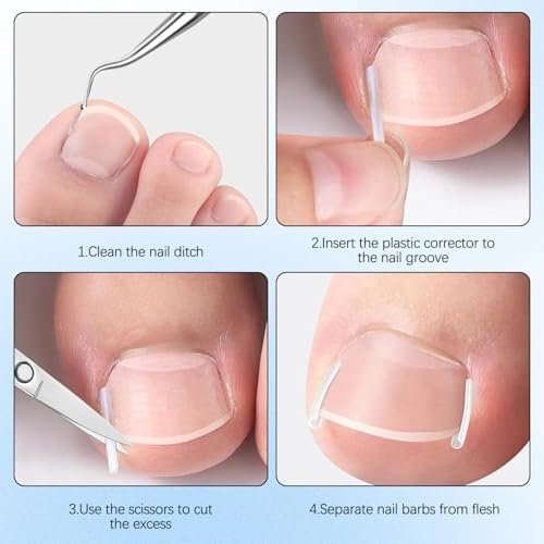 Ingrown Toenail Corrector Set with Correction Strips - Professional Pedicure Tool for Men and Women - görsel 12