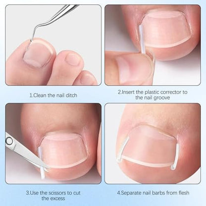 Ingrown Toenail Corrector Set with Correction Strips - Professional Pedicure Tool for Men and Women