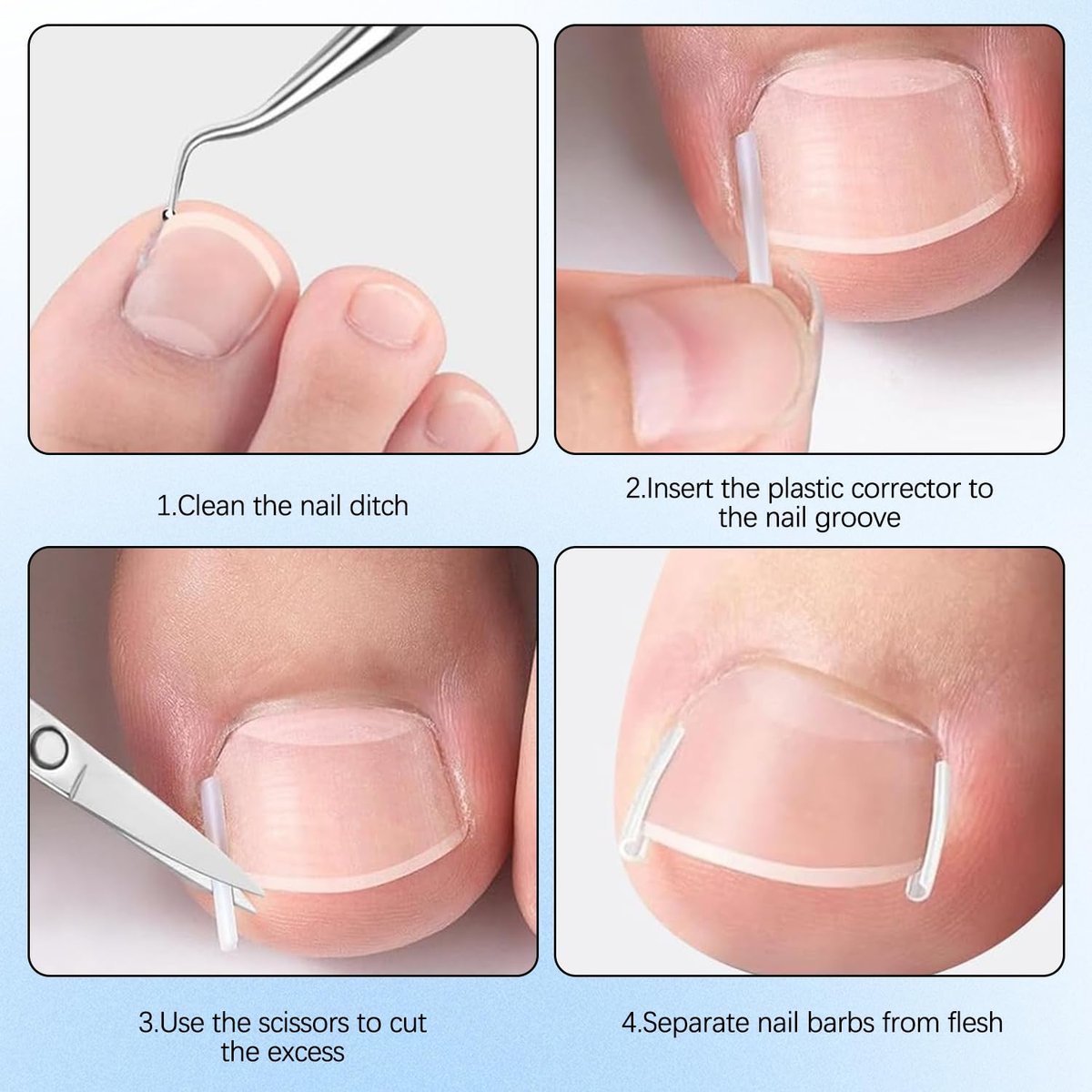 Ingrown Toenail Corrector Set with Correction Strips - Professional Pedicure Tool for Men and Women - görsel 11