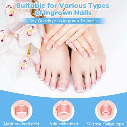 Ingrown Toenail Removal Kit with Corrective Strips, File, and Lifter – Maliyscent