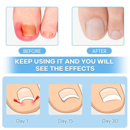 Ingrown Toenail Removal Kit with Corrective Strips, File, and Lifter – Maliyscent