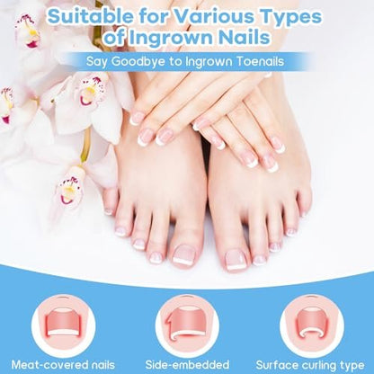 Ingrown Toenail Removal Kit with Corrective Strips, File, and Lifter – Maliyscent