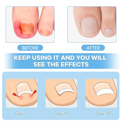 Ingrown Toenail Removal Kit with Corrective Strips, File, and Lifter – Maliyscent - görsel 4