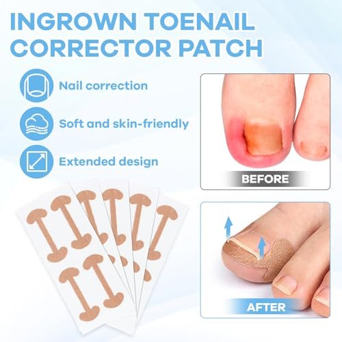 Ingrown Toenail Removal Kit with Corrective Strips, File, and Lifter – Maliyscent - görsel 6