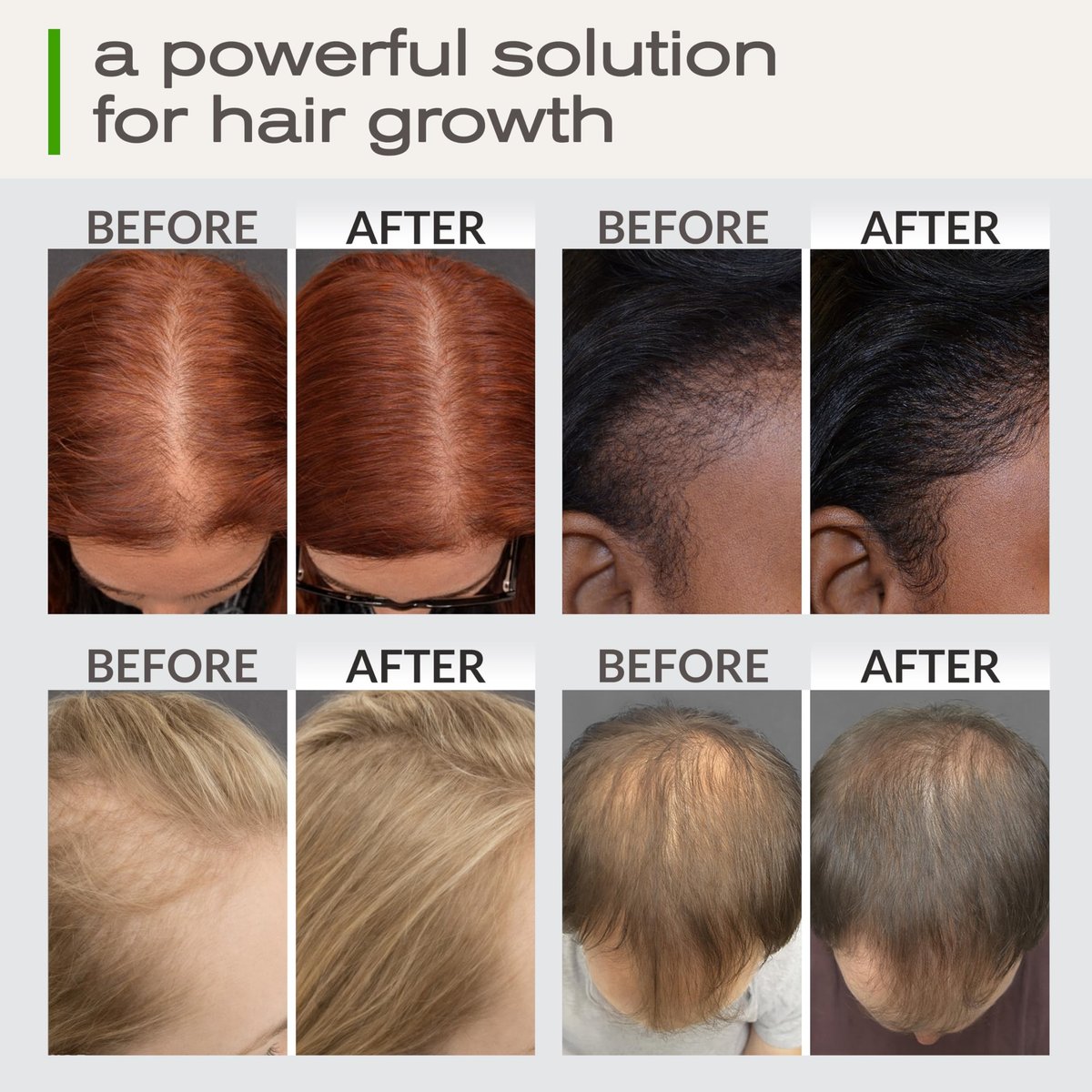 Ella & Eden Hair Growth Oil with Rosemary, Castor, Peppermint Oils & Biotin - Dry Scalp Treatment - Strengthening, Repairing, Soothing - 2 Fl Oz Glass Bottle - görsel 3