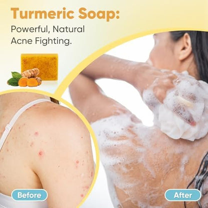 Treeroot Turmeric Soap 5 Pack - Kojic Acid Turmeric Soap Bar with Retinol, Collagen, Vitamin C & Shea Butter for Face & Body, SLS Free, 80g Each