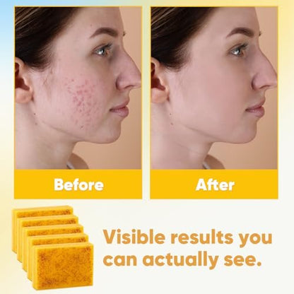 Treeroot Turmeric Soap 5 Pack - Kojic Acid Turmeric Soap Bar with Retinol, Collagen, Vitamin C & Shea Butter for Face & Body, SLS Free, 80g Each