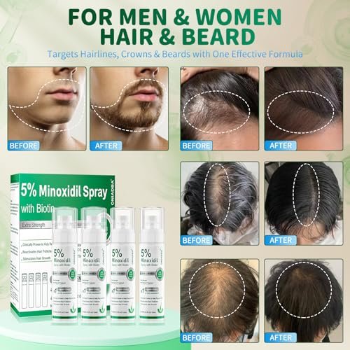 5% Minoxidil Spray for Hair Growth, 4 Pack (8.12oz), For Men & Women – Extra Strength Hair Regrowth Treatment with Biotin & Castor Oil, Supports Thicker Fuller Hair & Beard, Non-Greasy 4-Month Supply Avelisse
