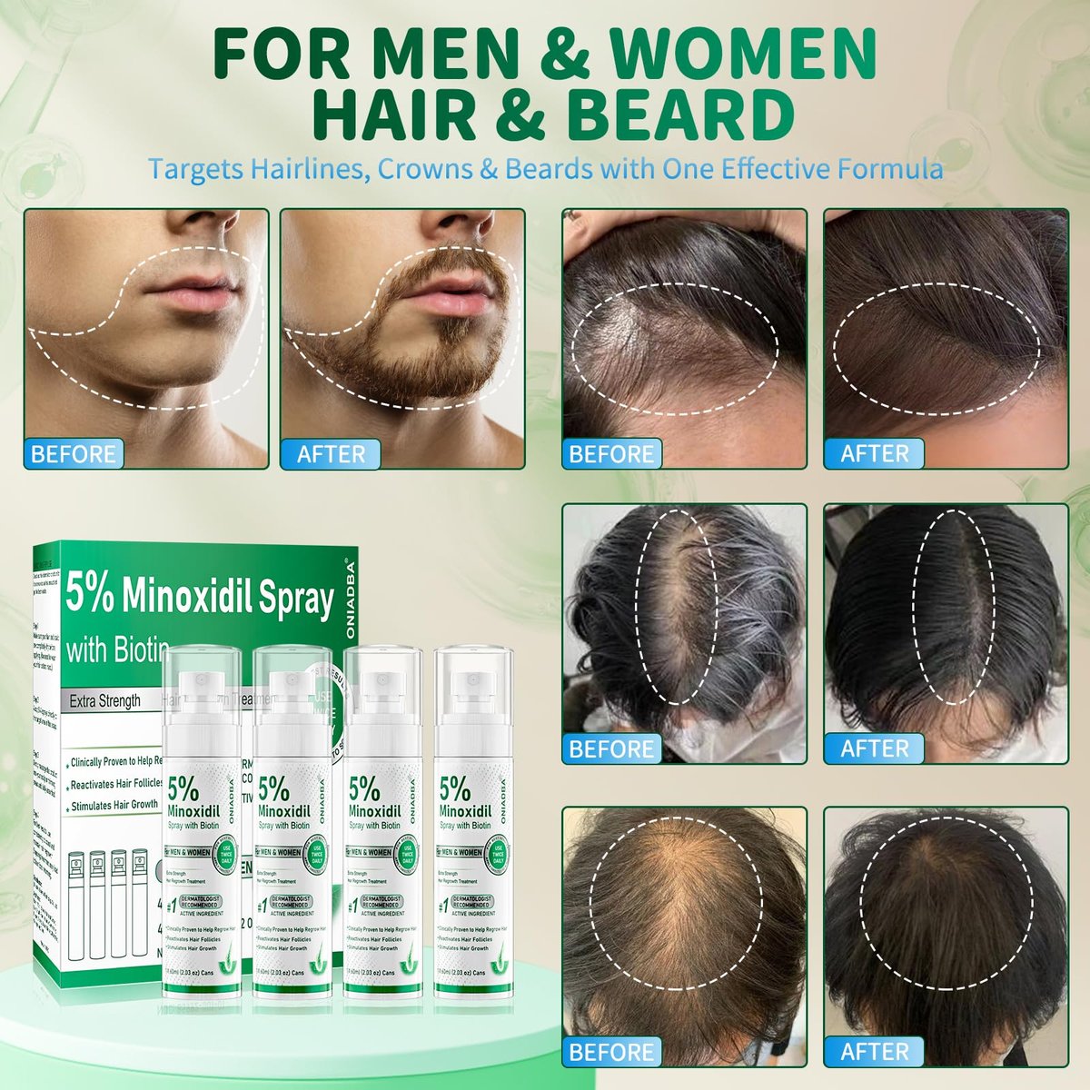 5% Minoxidil Spray for Hair Growth, 4 Pack (8.12oz), For Men & Women – Extra Strength Hair Regrowth Treatment with Biotin & Castor Oil, Supports Thicker Fuller Hair & Beard, Non-Greasy 4-Month Supply Avelisse