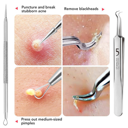Litbear 6-Piece Stainless Steel Blackhead Remover Tool Kit with Leather Case – Pimple Popper & Acne Extractor for Deep Cleansing